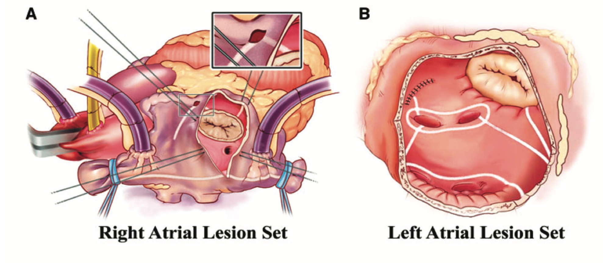 Convergent “Plus” Approach EP Lab Digest